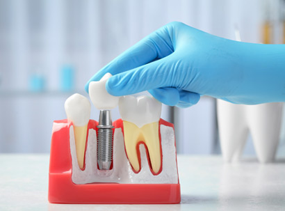 Periodoncia e implantes