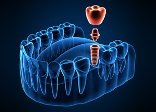 implantes viña del mar implantes viña del mar